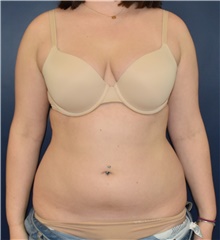Liposuction Before Photo by Richard Reish, MD, FACS; New York, NY - Case 43448