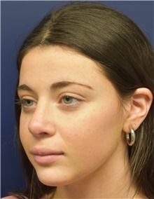 Rhinoplasty After Photo by Richard Reish, MD, FACS; New York, NY - Case 43480