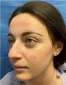 Rhinoplasty Before Photo by Richard Reish, MD, FACS; New York, NY - Case 43480