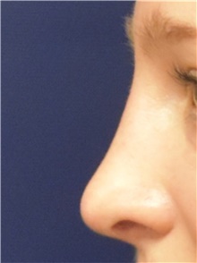 Rhinoplasty After Photo by Richard Reish, MD, FACS; New York, NY - Case 43495