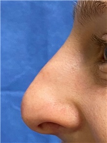 Rhinoplasty Before Photo by Richard Reish, MD, FACS; New York, NY - Case 43495