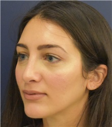 Rhinoplasty After Photo by Richard Reish, MD, FACS; New York, NY - Case 43538