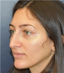 Rhinoplasty Before Photo by Richard Reish, MD, FACS; New York, NY - Case 43538