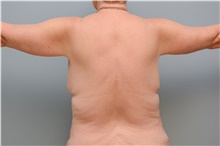 Body Contouring After Photo by Carlos Rivera-Serrano, MD; ,  - Case 43629