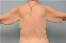 Body Contouring Before Photo by Carlos Rivera-Serrano, MD; ,  - Case 43629