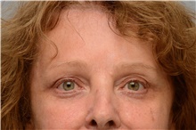 Botulinum Toxin After Photo by Carlos Rivera-Serrano, MD; ,  - Case 43630