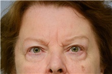 Botulinum Toxin Before Photo by Carlos Rivera-Serrano, MD; ,  - Case 43630