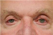 Botulinum Toxin After Photo by Carlos Rivera-Serrano, MD; ,  - Case 43631