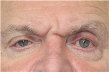Botulinum Toxin Before Photo by Carlos Rivera-Serrano, MD; ,  - Case 43631
