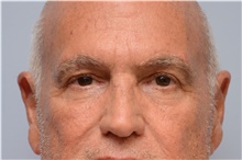 Botulinum Toxin After Photo by Carlos Rivera-Serrano, MD; ,  - Case 43632