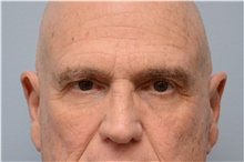 Botulinum Toxin Before Photo by Carlos Rivera-Serrano, MD; ,  - Case 43632