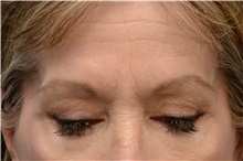 Botulinum Toxin Before Photo by Carlos Rivera-Serrano, MD; ,  - Case 43633
