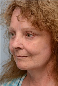 Facelift After Photo by Carlos Rivera-Serrano, MD; ,  - Case 43694