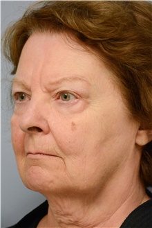 Facelift Before Photo by Carlos Rivera-Serrano, MD; ,  - Case 43694