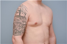 Male Breast Reduction After Photo by Carlos Rivera-Serrano, MD; ,  - Case 43710