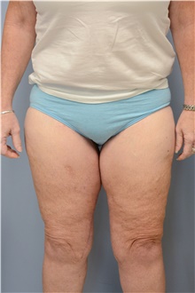 Thigh Lift After Photo by Carlos Rivera-Serrano, MD; ,  - Case 43747