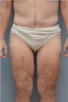 Thigh Lift Before Photo by Carlos Rivera-Serrano, MD; ,  - Case 43747