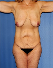 Body Lift Before Photo by Siamak Agha, MD PhD FACS; ,  - Case 43866