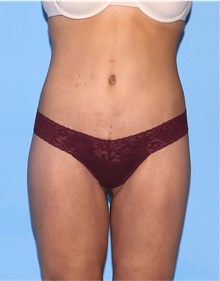 Body Lift After Photo by Siamak Agha, MD PhD FACS; ,  - Case 43870