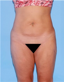 Body Lift Before Photo by Siamak Agha, MD PhD FACS; ,  - Case 43870