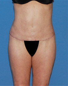 Body Lift After Photo by Siamak Agha, MD PhD FACS; ,  - Case 43875