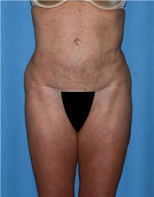 Body Lift Before Photo by Siamak Agha, MD PhD FACS; ,  - Case 43875