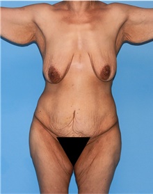 Body Lift Before Photo by Siamak Agha, MD PhD FACS; ,  - Case 43929