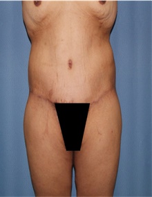 Body Lift After Photo by Siamak Agha, MD PhD FACS; ,  - Case 43981
