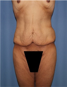 Body Lift Before Photo by Siamak Agha, MD PhD FACS; ,  - Case 43981