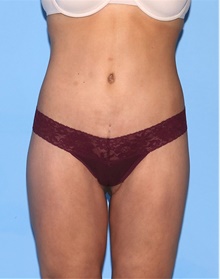 Body Contouring After Photo by Siamak Agha, MD PhD FACS; ,  - Case 44040