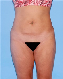 Body Contouring Before Photo by Siamak Agha, MD PhD FACS; ,  - Case 44040