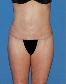 Body Contouring After Photo by Siamak Agha, MD PhD FACS; ,  - Case 44048