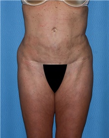 Body Contouring Before Photo by Siamak Agha, MD PhD FACS; ,  - Case 44048