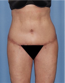 Body Contouring After Photo by Siamak Agha, MD PhD FACS; ,  - Case 44073