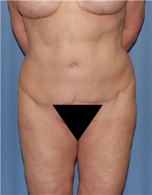 Body Contouring Before Photo by Siamak Agha, MD PhD FACS; ,  - Case 44073