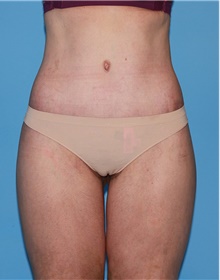 Body Contouring After Photo by Siamak Agha, MD PhD FACS; ,  - Case 44078