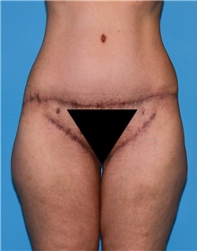 Body Contouring Before Photo by Siamak Agha, MD PhD FACS; ,  - Case 44078