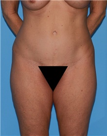 Body Contouring Before Photo by Siamak Agha, MD PhD FACS; ,  - Case 44094