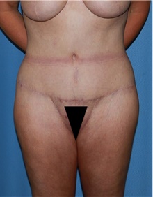 Body Contouring After Photo by Siamak Agha, MD PhD FACS; ,  - Case 44101