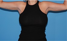Arm Lift After Photo by Siamak Agha, MD PhD FACS; ,  - Case 44133