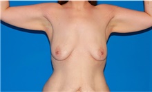 Arm Lift Before Photo by Siamak Agha, MD PhD FACS; ,  - Case 44133