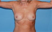 Body Contouring After Photo by Siamak Agha, MD PhD FACS; ,  - Case 44142