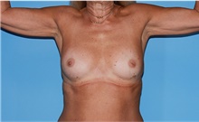 Body Contouring Before Photo by Siamak Agha, MD PhD FACS; ,  - Case 44142