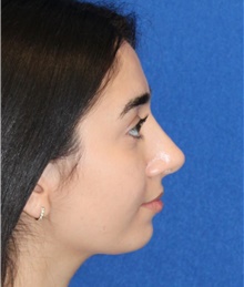 Rhinoplasty After Photo by Ali Sajjadian, M.D., F.A.C.S.; ,  - Case 44215