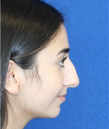 Rhinoplasty Before Photo by Ali Sajjadian, M.D., F.A.C.S.; ,  - Case 44215