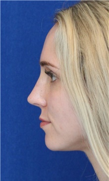 Rhinoplasty After Photo by Ali Sajjadian, M.D., F.A.C.S.; ,  - Case 44227
