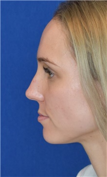 Rhinoplasty Before Photo by Ali Sajjadian, M.D., F.A.C.S.; ,  - Case 44227