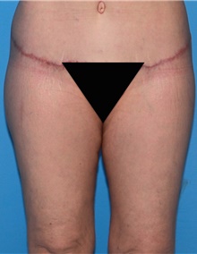 Thigh Lift After Photo by Siamak Agha, MD PhD FACS; ,  - Case 44534