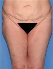 Thigh Lift Before Photo by Siamak Agha, MD PhD FACS; ,  - Case 44534