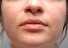 Lip Augmentation/Enhancement After Photo by Ellen Mahony, MD; Westport, CT - Case 44561
